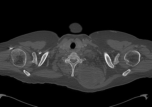 Chondrosarcoma - chest wall (Radiopaedia 65192-74199 Axial bone window 6).jpg