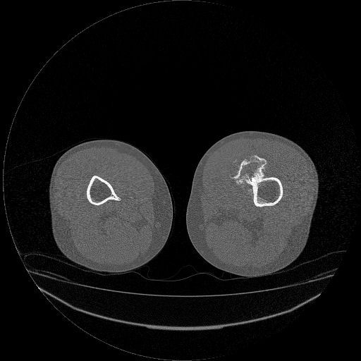 File:Chondrosarcoma arising from exostosis (Radiopaedia 59996-67507 Axial bone window 18).jpg