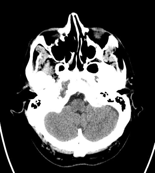 File:Chondrosarcoma of skull base- grade II (Radiopaedia 40948-43653 Axial Contrast 5).png