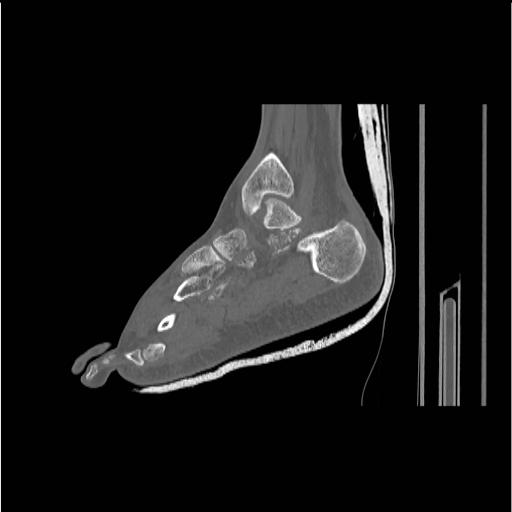 File:Chopart fracture (Radiopaedia 12386-12650 Sagittal bone window 23).jpg