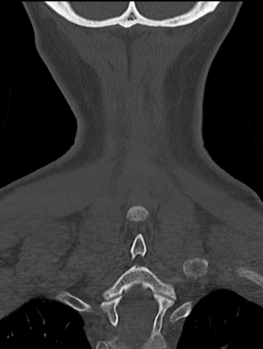 Chordoma (C4 vertebra) (Radiopaedia 47561-52188 Coronal bone window 55).png