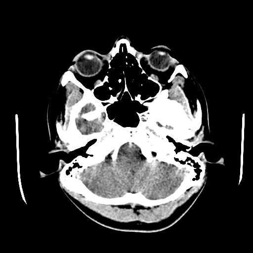 File:Choriocarcinoma of ovary with cerebral and pulmonary metastases (Radiopaedia 25983-26118 C+ arterial phase 19).jpg