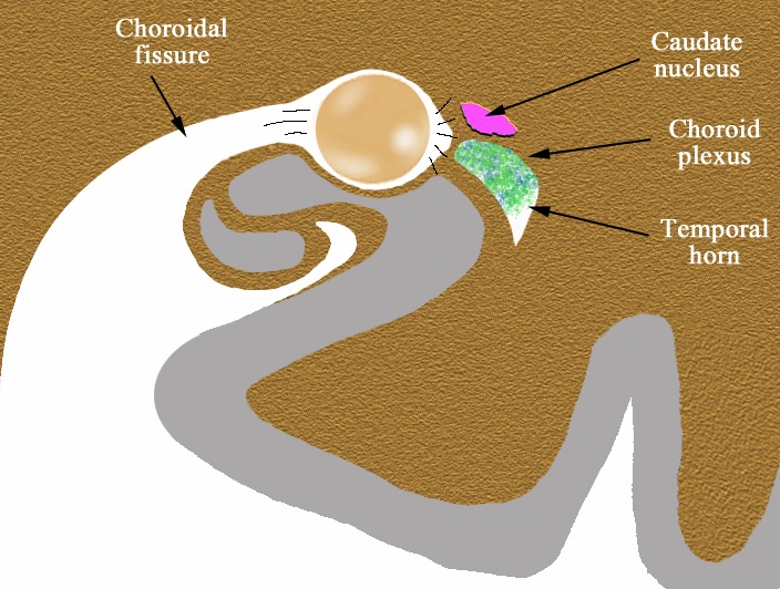 File:Choroidal fissure (diagram) (Radiopaedia 59364-97484 Coronal plane 1).jpg