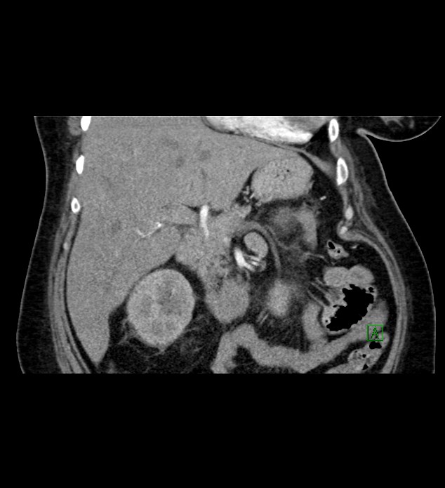 Chromophobe renal cell carcinoma (Radiopaedia 84239-99519 C 38).jpg