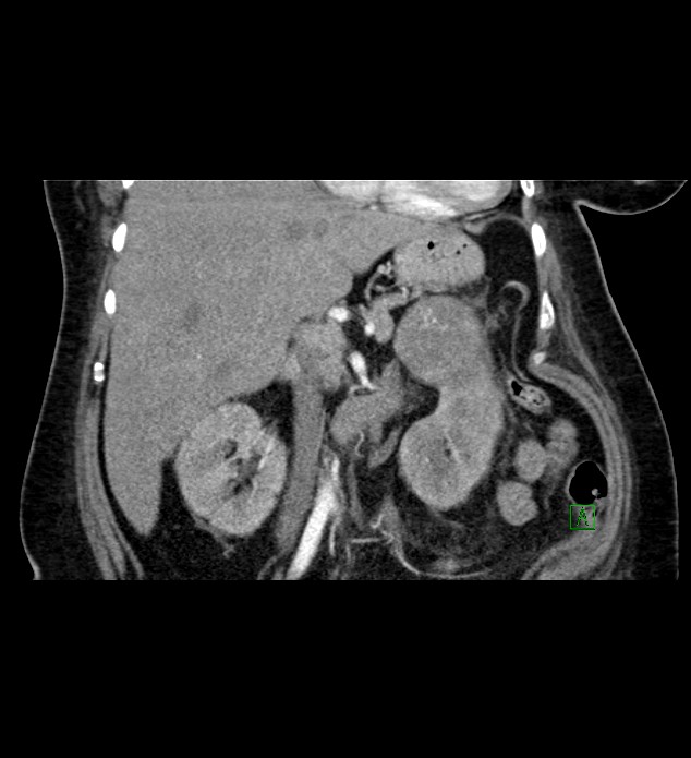 Chromophobe renal cell carcinoma (Radiopaedia 84239-99519 C 43).jpg