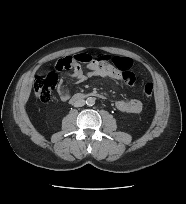 Chromophobe renal cell carcinoma (Radiopaedia 86879-103083 D 74).jpg