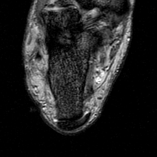 File:Chronic Achilles tendon rupture (Radiopaedia 15262-15100 Axial Gradient Echo 21).jpg