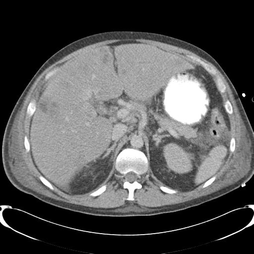 Chronic diverticulitis complicated by hepatic abscess and portal vein thrombosis (Radiopaedia 30301-30938 A 30).jpg