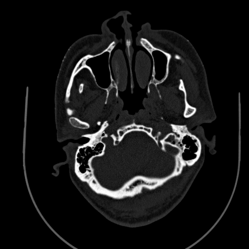 Chronic invasive fungal sinusitis (Radiopaedia 91563-109286 Axial sinus 10).jpg