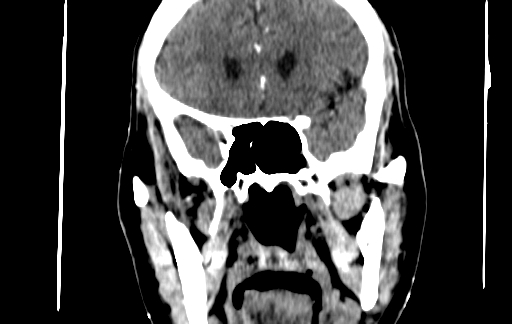 Chronic invasive fungal sinusitis (Radiopaedia 91563-109286 D 84).jpg