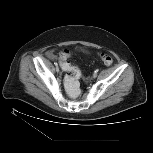 Chronic mesenteric ischemia - arterial (Radiopaedia 88205-104810 A 69).jpg