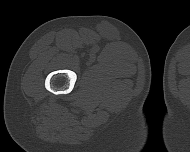 Chronic ostemyelitis of the femur with long sinus tract (Radiopaedia 74947-85982 Axial bone window 37).jpg