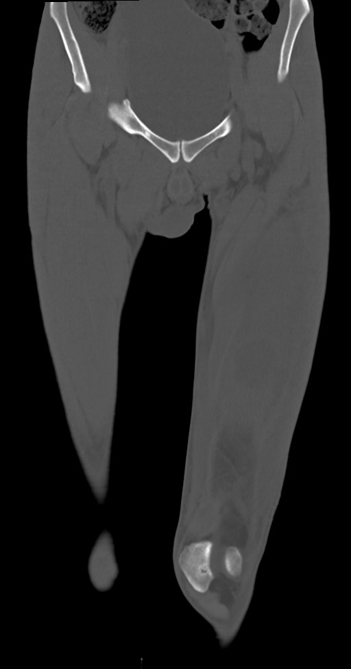 Chronic osteomyelitis (with sequestrum) (Radiopaedia 74813-85822 Coronal non-contrast 14).jpg