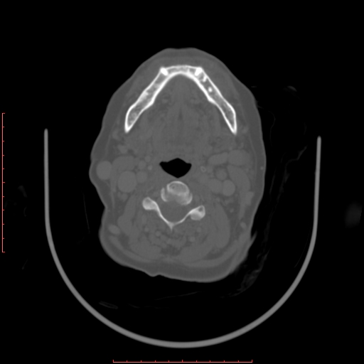 Chronic osteomyelitis - maxilla (Radiopaedia 23783-23927 Axial bone window 28).jpg