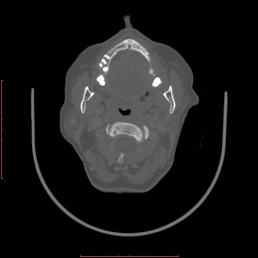 Chronic osteomyelitis - maxilla (Radiopaedia 23783-23927 Axial bone window 71).jpg