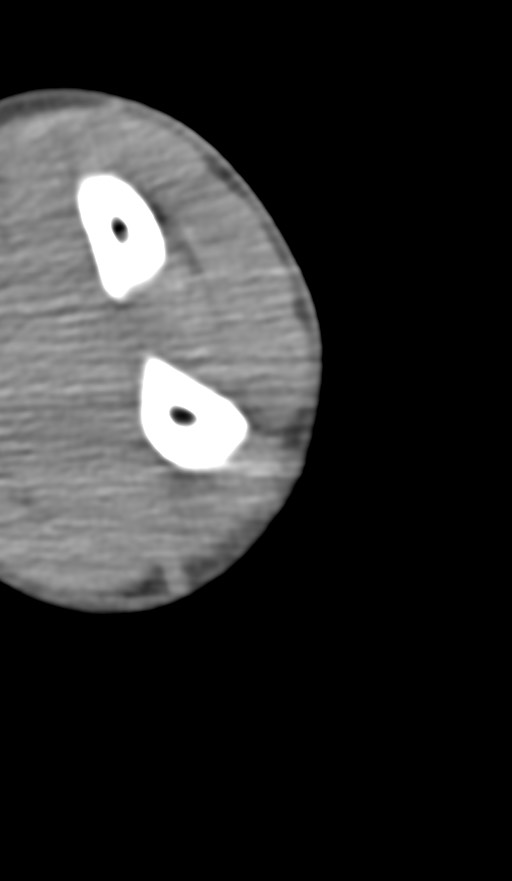 Chronic osteomyelitis of the distal humerus (Radiopaedia 78351-90971 Axial non-contrast 131).jpg
