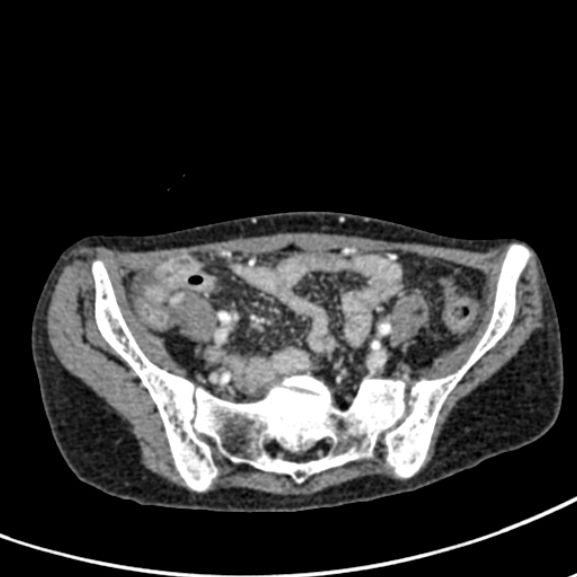 File:Chronic pancreatitis (Radiopaedia 55405-61846 A 80).jpg