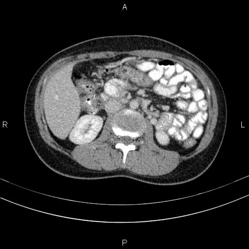 Chronic pancreatitis (Radiopaedia 64576-73450 C 74).jpg