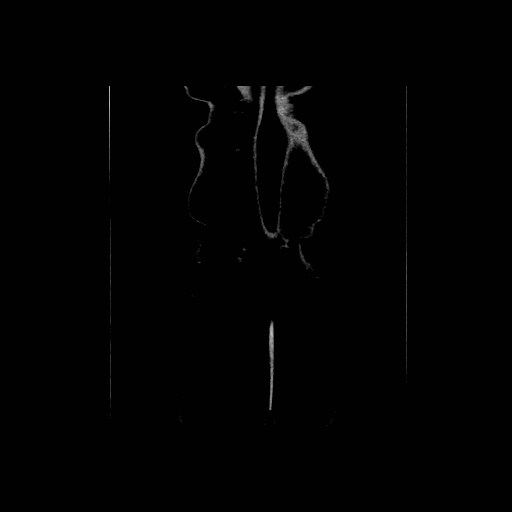 Chronic portal venous thrombosis with cavernous transformation (Radiopaedia 73618-84398 B 98).jpg