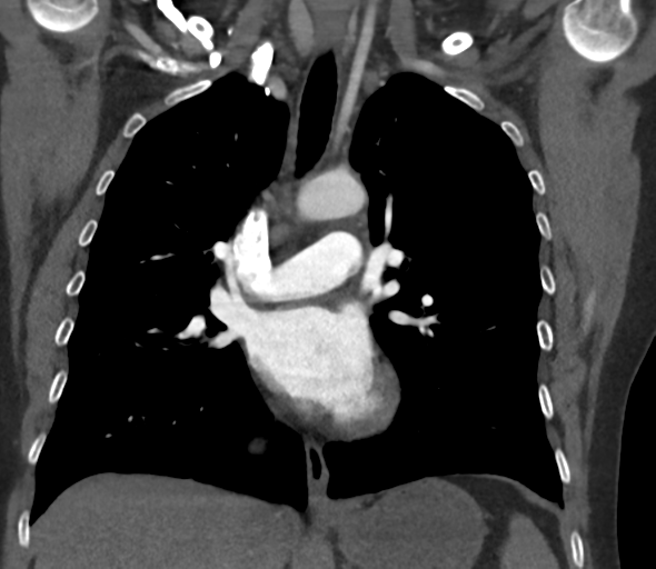 Chronic pulmonary embolus (Radiopaedia 39129-41341 Coronal C+ CTPA 44).png