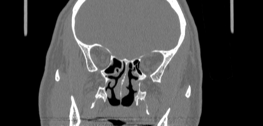 Chronic sphenoidal sinusitis (Radiopaedia 62030-70122 Coronal bone window 88).jpg