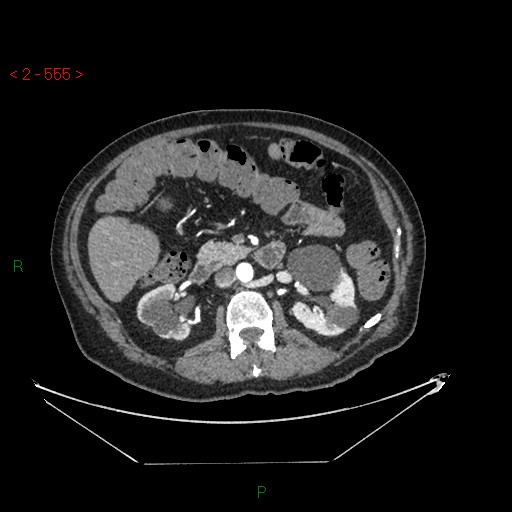 Circumaortic left renal vein and doubled left renal arteries (Radiopaedia 52268-58158 A 91).jpg