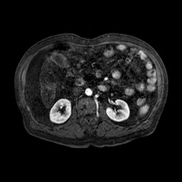 Cirrhosis and hepatocellular carcinoma in the setting of hemochromatosis (Radiopaedia 75394-86594 Axial T1 C+ fat sat 104).jpg