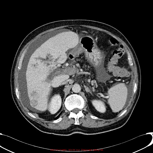 Cirrhosis and hepatocellular carcinoma in the setting of hemochromatosis (Radiopaedia 75394-86595 B 31).jpg
