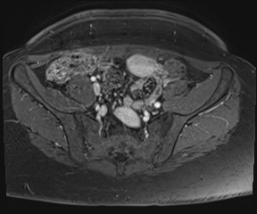 File:Class II Mullerian duct anomaly- unicornuate uterus with rudimentary horn and non-communicating cavity (Radiopaedia 39441-41755 Axial T1 fat sat 14).jpg