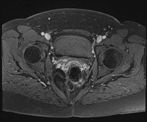 File:Class II Mullerian duct anomaly- unicornuate uterus with rudimentary horn and non-communicating cavity (Radiopaedia 39441-41755 Axial T1 fat sat 98).jpg