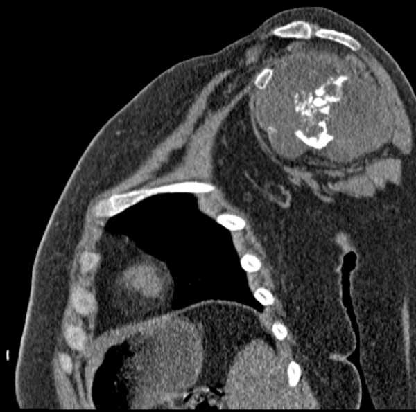 File:Clear cell chondrosarcoma - humerus (Radiopaedia 63104-71612 D 32).jpg
