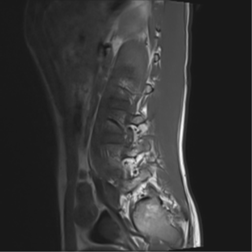 File:Clear cell meningoma - lumbar spine (Radiopaedia 60116-67690 Sagittal T1 3).png