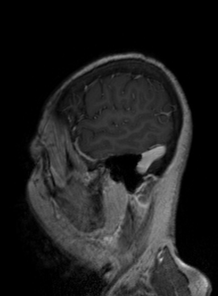 File:Clival meningioma (Radiopaedia 53278-59248 Sagittal T1 C+ 155).jpg