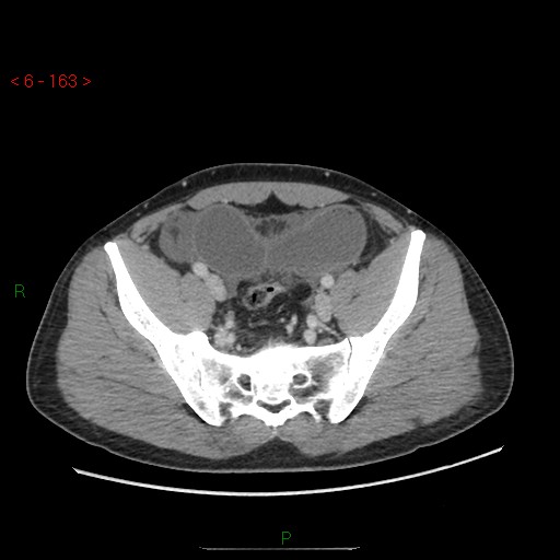 File:Closed loop obstruction and appendicular stump mucocele (Radiopaedia 54014-60163 A 97).jpg
