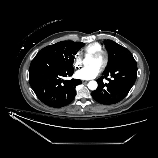 File:Closed loop obstruction due to adhesive band, resulting in small bowel ischemia and resection (Radiopaedia 83835-99023 Axial 371).jpg