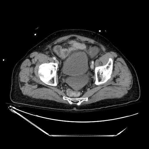 File:Closed loop obstruction due to adhesive band, resulting in small bowel ischemia and resection (Radiopaedia 83835-99023 D 137).jpg