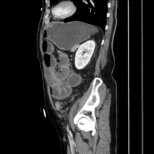File:Closed loop obstruction due to adhesive band, resulting in small bowel ischemia and resection (Radiopaedia 83835-99023 F 132).jpg