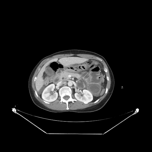 Closed loop small bowel obstruction (Radiopaedia 68471-78022 A 91).jpg