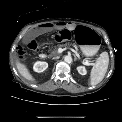 Closed loop small bowel obstruction - adhesive disease and hemorrhagic ischemia (Radiopaedia 86831-102990 A 70).jpg