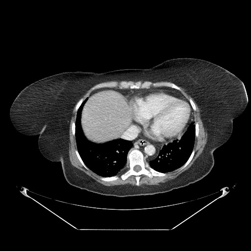 Closed loop small bowel obstruction - internal hernia (Radiopaedia 65402-74450 A 4).jpg