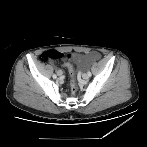 Closed loop small bowel obstruction - omental adhesion causing "internal hernia" (Radiopaedia 85129-100682 A 137).jpg