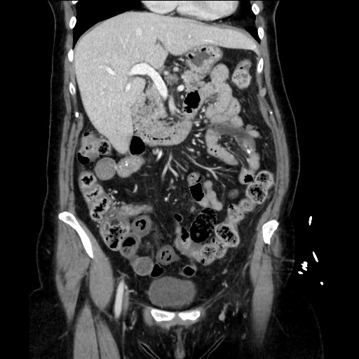 Closed loop small bowel obstruction due to adhesive bands - early and late images (Radiopaedia 83830-99014 B 50).jpg