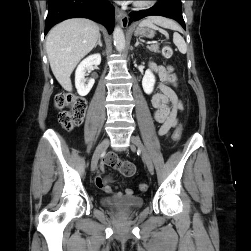 Closed loop small bowel obstruction due to adhesive bands - early and late images (Radiopaedia 83830-99014 B 73).jpg