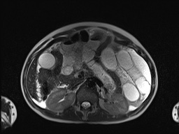 File:Closed loop small bowel obstruction in pregnancy (MRI) (Radiopaedia 87637-104031 Axial T2 25).jpg