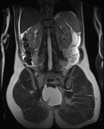 File:Closed loop small bowel obstruction in pregnancy (MRI) (Radiopaedia 87637-104031 Coronal T2 41).jpg