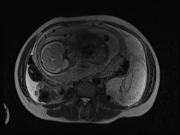 Closed loop small bowel obstruction in pregnancy (MRI) (Radiopaedia 87637-104031 D 4).jpg