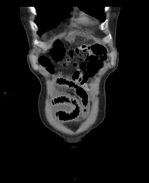File:Closed loop small bowel obstruction with ischemia (Radiopaedia 84180-99456 B 60).jpg