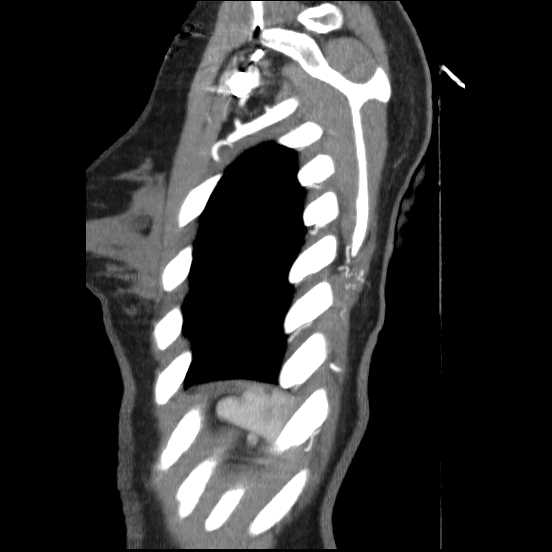 File:Coarctation of the aorta (Radiopaedia 67609-77010 C 7).jpg