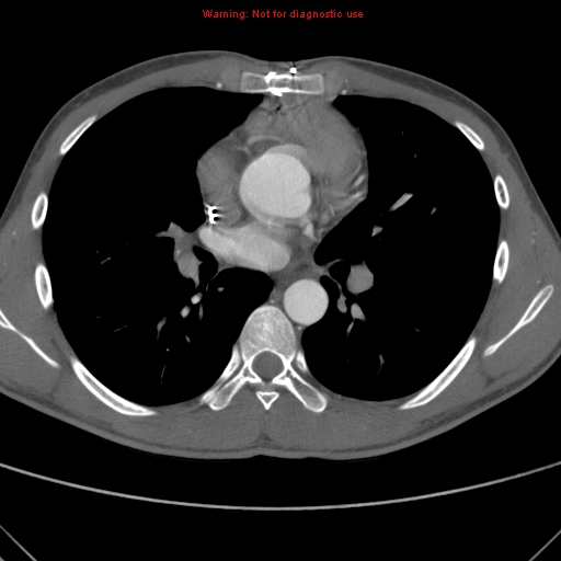 File:Coarctation of the aorta (Radiopaedia 9434-10118 A 95).jpg