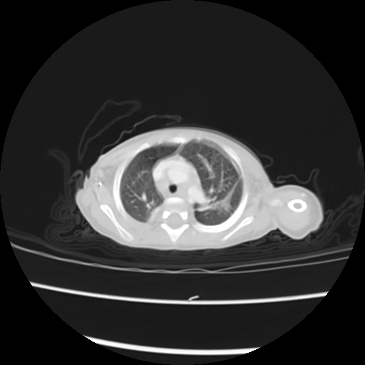 Coarctation of the aorta and patent ductus arteriosus (Radiopaedia 68033-77499 Axial lung window 10).jpg